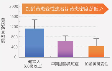 加齢黄斑変性患者は黄斑密度が低い