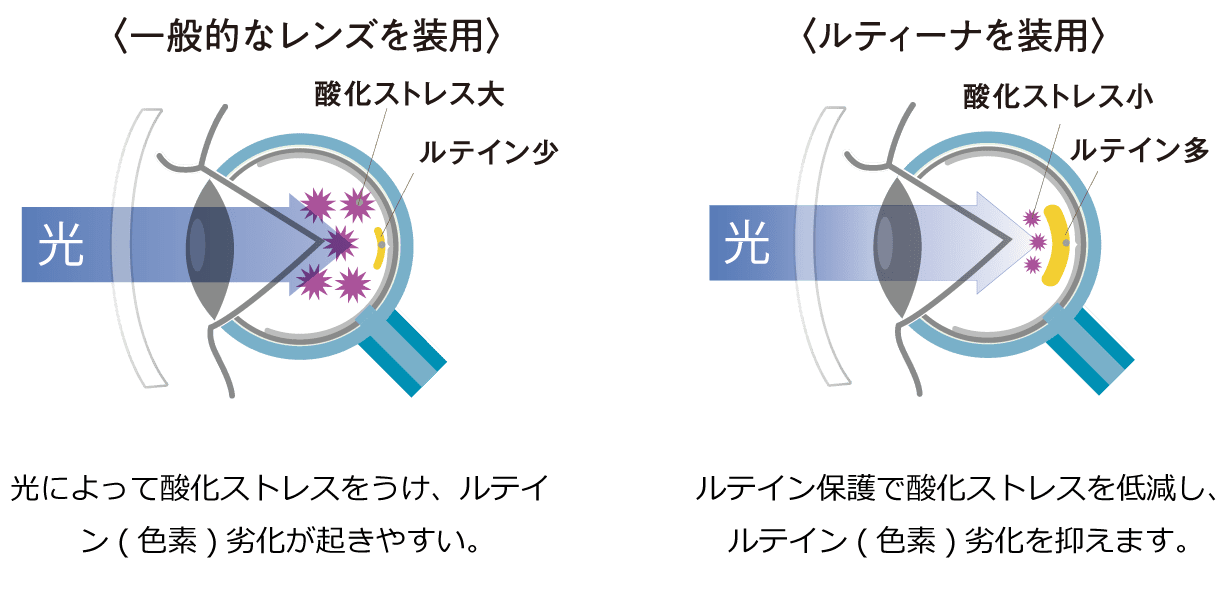 一般的なレンズを装用 ルティーナ装用