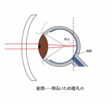 瞳孔が明るい場所で閉じ（縮瞳）、光が網膜で結ぶことで輪郭がはっきり見える仕組みの図